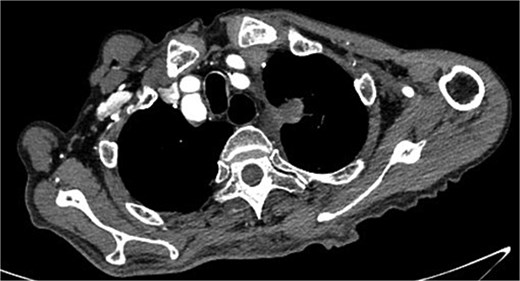 Lung CT results revealed no lung lesions associated with blood in sputum.