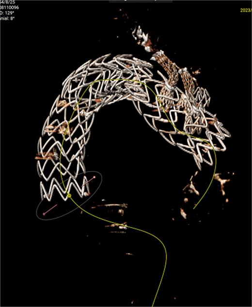 In July 2023, endoleak was observed upon reexamination, possibly of stent graft origin.