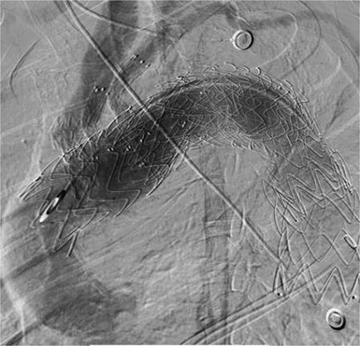 The thoracic aorta was re-implanted with a covered stent graft to cover the breach.