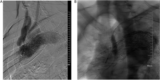 (A) It was hypothesized that the gore aortic stent graft compressed the original subclavian artery BD stent graft, causing a type Ic endoleak. (B) Left subclavian artery stent graft implantation and balloon dilation on December 4, 2023, improved the endoleak.