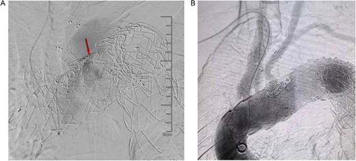 (A) On March 1, 2024, the angiography showed endoleak (marked by arrows) at overlapping part of stent graft. (B) Dense embolization was performed on the residual breach of the stent graft membrane.