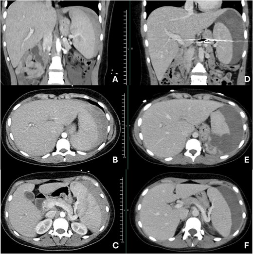 Images A, B, and C are representations of initial imaging prior to splenic artery embolization. Images D, E, and F are images taken at her second admission, 12 days after splenic artery embolization. Images D and F show continued flow through the splenic artery.