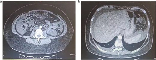 (a) Abdominal CT, multiple bowel loops are seen surrounded by liquid. (b) Abdominal CT, thickening of the peritoneum is seen with free liquid.