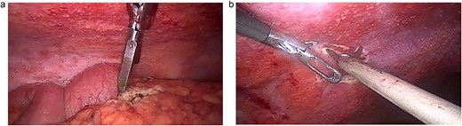 (a) Laparoscopy, the peritoneum is filled with lesions. (b) Laparoscopy, the intestine and omentum are completely covered in nodules.