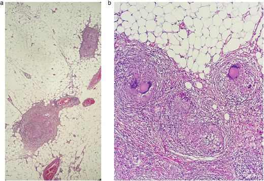 (a) Sections processed by hematoxylin and eosin staining. A tuberculous granuloma, multiple lymphocytes, and plasma cells are seen surrounded by a peripheral rim of multinucleate giant cells in the biopsy of the peritoneum. (b) Sections processed by hematoxylin and eosin staining, two granulomas are seen in the biopsy of the omentum.