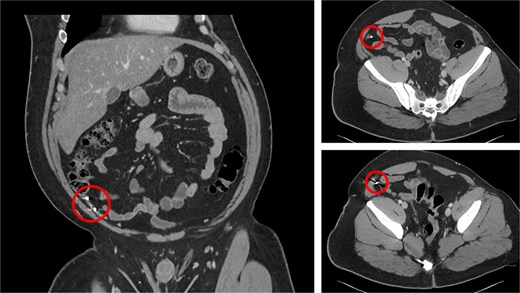CT of the abdomen of the patient.