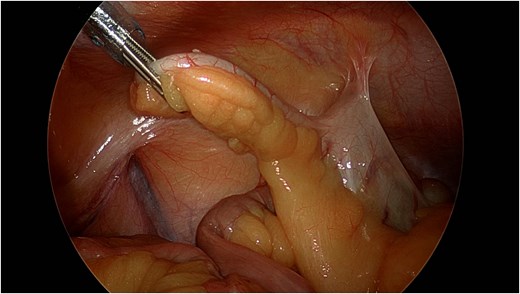 Laparoscopic view of the inflamed appendix.