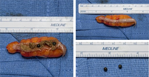 Appendix at bedside with retained buckshot.