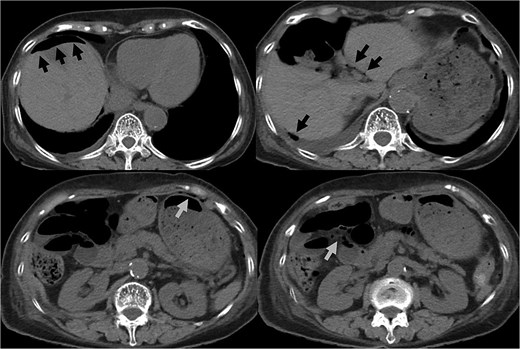 CT indicated intra-abdominal free air (arrows). These findings were later confirmed as being due to bladder rupture.