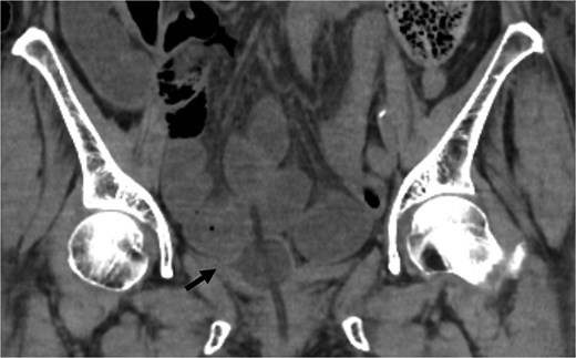 Coronal CT showed the urinary catheter was mispositioned outside the bladder (arrow).
