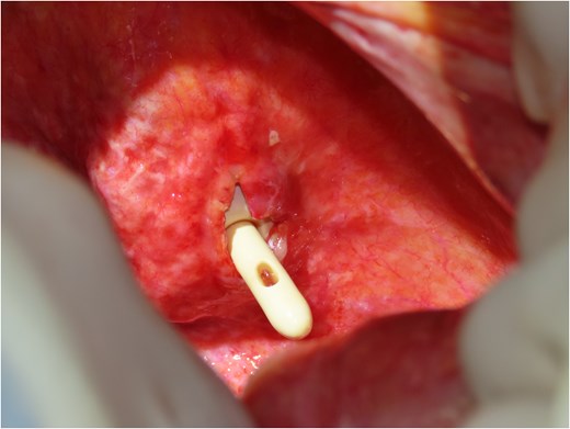 Intraoperative findings reveal bladder rupture with the urinary catheter protruding through the bladder wall. The bladder wall appears thin and fragile, consistent with radiation-induced damage.
