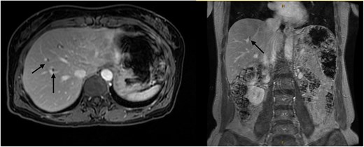Magnetic resonance imaging liver/MRCP demonstrating subtle intrahepatic biliary dilatation (arrows), most pronounced in segment 8.