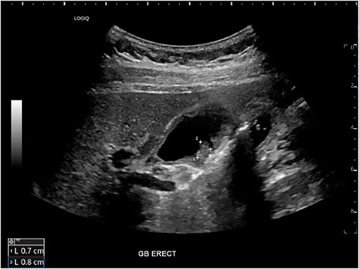 Preoperative ultrasound showing gallbladder polyp and wall thickening.
