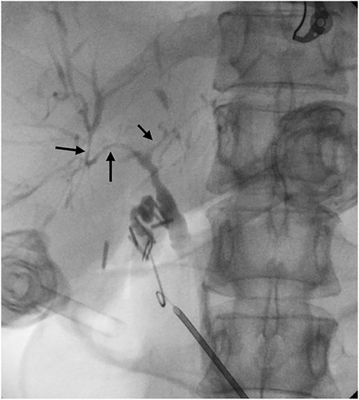 Intraoperative cholangiogram demonstrating intrahepatic duct stricturing (arrows) consistent with PSC.