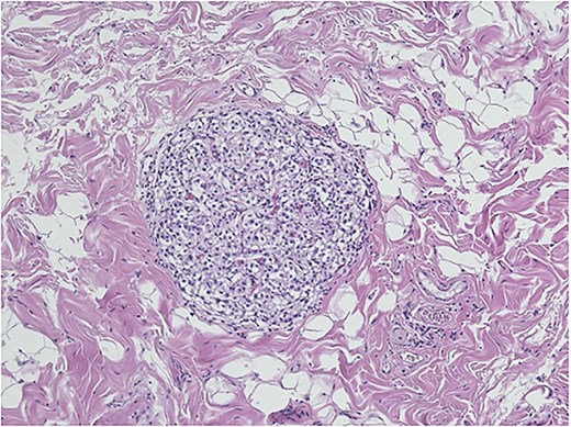 Gallbladder paraganglioma with characteristic Zellballen pattern seen in hematoxylin and eosin, ×20.