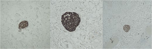 Immunohistochemistry for chromogranin (left), synaptophysin (middle), and S-100 (right).