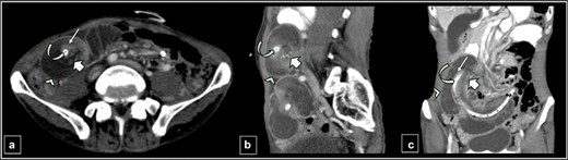 Contrast-enhanced CT abdomen images of axial (a), sagittal (b), and coronal (c) sections showing the jejunojejunal intussusception with a target sign. The structures from outer to inner: grossly dilated intussuscipiens-distal jejunal loop (arrow head), the intussusceptum-proximal jejunal loop (long thin arrow), proximal jejunal mesenteric fat and the vessels (short thick arrow) within the intussuscipiens, and the feeding jejunostomy tube (curved arrow) within the intussusceptum.
