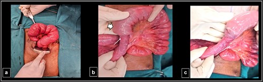 Intraoperative findings. (a) Significant small bowel dilatation. (b) Intussusception part identified with intussusceptum-proximal jejunal loop (long thin arrow) and dilated intussuscipiens-distal jejunal loop (short thick arrow). (c) Post reduction of intussusception.