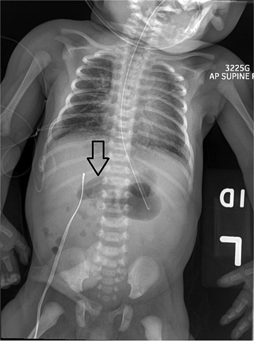Abdominal X-ray shows nonspecific gas pattern with gas-filled, nondistended bowel loops on the right. Absence of small bowel gas on the left raises suspicion for malrotation.