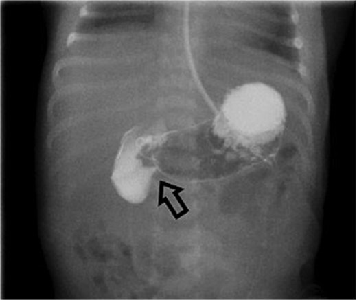 Initial UGI series demonstrates abnormally dilated descending duodenum with no contrast crossing the midline. Findings are consistent with obstruction.