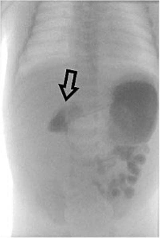 Repeat UGI series reveals delayed transit from the second to fourth portions of the duodenum, suggestive of partial obstruction likely due to adhesions.