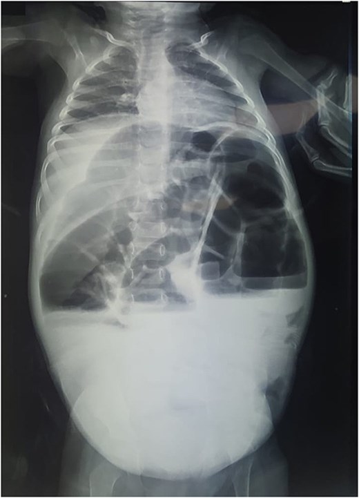 X-ray image showing intestinal-type hydroaeric levels and gastric stasis.