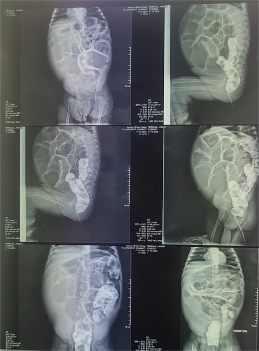 Barium index suggesting an upper intestinal obstruction.