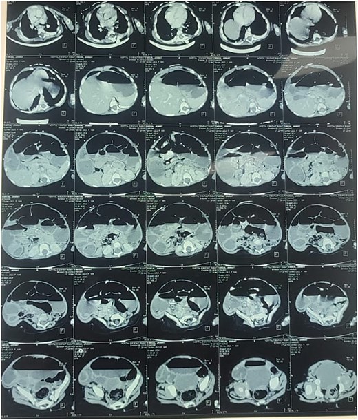 Enteroscan image showing an intestinal distension downstream of an obstacle.