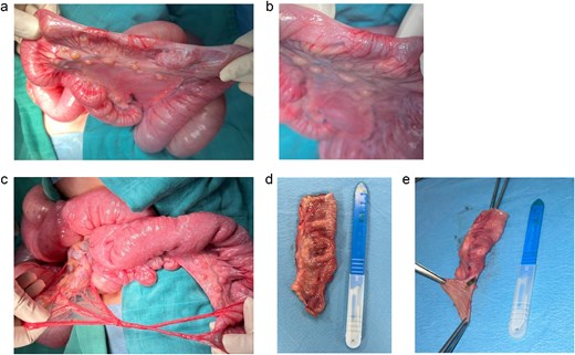 Surgery images. (a) Surgery imaging showing the type one jejunal atresia in our patient. (b) Surgery imaging showing the type one jejunal atresia in our patient (close up picture). (c) Congenital bands. (d and e) Resected segment carrying the diaphragm.