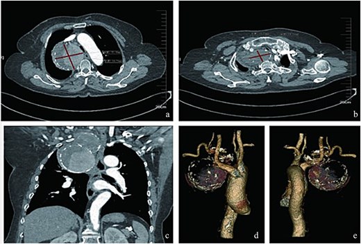 Radiologic characteristics of the SAA. (a) Axial CTA demonstrates a bipartite aneurysm morphology with superior–inferior compartmentalization. The inferior spherical component measures 70.05 mm (long axis) × 69.73 mm (short axis), exhibiting regular contour and homogeneous attenuation. (b) The superior ellipsoid component displays dimensions of 51.81 mm (long axis) × 35.59 mm (short axis), with peripheral thrombus formation. (c) Coronal reformation reveals the characteristic gourd-shaped configuration and intraluminal thrombus burden. (d and e) Volume-rendered reconstructions delineate circumferential calcifications along the aneurysm wall, particularly prominent at the inflow/outflow transitional zone.
