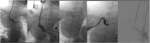 Endovascular procedural steps. (a) Pre-interventional angiography identifies the SAA originating from the ostium of the right subclavian artery. (b) Fluoroscopic guidance demonstrates retrograde deployment of the tapered stent-graft through the common carotid artery approach, with real-time angiography confirming appropriate stent positioning. (c) Post-stent angiography reveals residual aneurysm cavity perfusion through persistent outflow tracts. (d) Selective embolization of the outflow artery using detachable coils (chevrons) achieves complete cavity obliteration. (e) Final control angiography documents technical success: Preserved patency of the brachiocephalic trunk and right common carotid artery, absence of endoleak, and delayed opacification of the distal subclavian artery via collateral circulation.