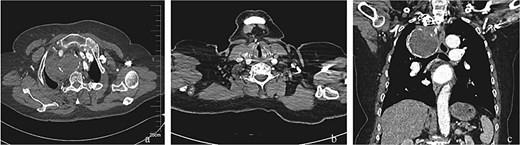 Post-interventional imaging surveillance at 4-month follow-up. (a) Axial CTA demonstrates complete thrombosis of the aneurysm sac following successful flow isolation, with volume reduction compared to pretreatment dimensions. (b) Sagittal reconstruction confirms absence of right vertebral artery opacification, consistent with deliberate ostial exclusion during the index procedure. (c) Coronal volume-rendered technique delineates organized thrombus within the collapsed aneurysm cavity, patency of the stent-graft lumen, and preserved distal subclavian artery perfusion through collateral channels. The radiopaque coil mass at the outflow tract confirms successful embolization endpoint achievement.