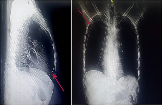 Chest X-ray posterior anterior and lateral view showing the intrathoracic metallic guide. The wire’s thin, linear shape is clearly visible, with an abrupt change in course around the cupola indicating its unintended migration from the subclavian vein into the chest cavity.