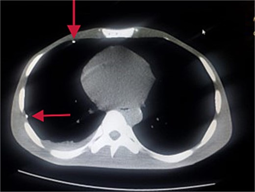 Thorax CT showing guide wire in the pleural space.