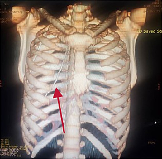 Reconstructed 3D image of the CT scan.