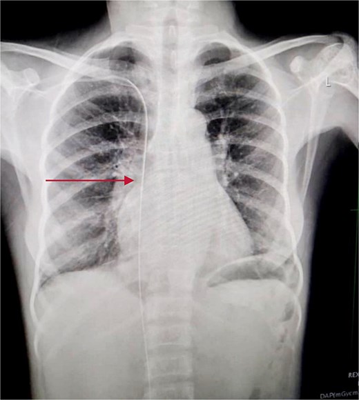 Chest X-ray showing guide wire extending from the right subclavian vein to the SVC and via the right atrium to the IVC.