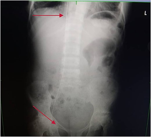 Plain abdominal X-ray extending from the IVC through the right iliac vein to the right femoral vein.