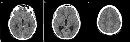 Head CT scan, axial slices. (a) Cystic lesion inside the posterior part of the third ventricle with a hyperdense content in the posterior part of the cyst; (b) probable calcifications in the cyst walls; (c) diffusely obliterated sulci of the convexity as a sign of obstructive hydrocephalus.