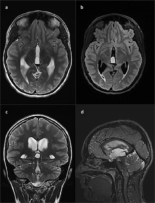 Brain MRI scan. (a) T2 weighted image, axial slice, pineal cyst occupying posterior part of the third ventricle with hemosiderin deposits in the posterior part of the cyst; (b) FLAIR image, axial slice, showing different contents inside the cyst when compared to CSF; (c) T2 weighted image, coronal slice, pineal cyst inside the lower part of the third ventricle, beneath internal cerebral veins; (d) T2 weighted image (SPACE), sagittal slice, showing pineal cyst in front of a rather large vein of Galeni, and compressing the cranial part of the cerebral aqueduct.