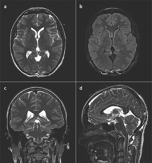 Postoperative brain MRI scan showing no residual tumor. (a) T2 weighted image, axial slice; (b) FLAIR image, axial slice; (c) T2 weighted image, coronal slice; (d) T2 weighted image (SPACE), sagittal slice).