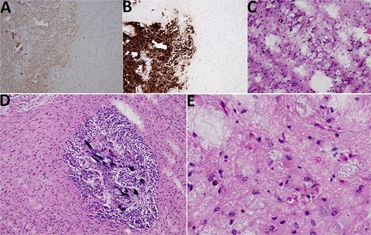 Histological findings. (A) NSE 100× magnification. NSE positivity in pineocytoma (on the left side) in contrast to PA (on the right side). (B) Synaptophysin 100× magnification. Synaptophysin positivity in pineocytoma (lower left quadrant) in contrast to PA (upper left and right side). (C) HE 200× magnification, PA. PA with microcystic vacuoles and Rosenthal fibers. (D) HE 100×. PA surrounding pineocytoma (microcalcifications inside pineocytoma can be seen). (E) HE 400×, PA. PA with Rosenthal fibers.