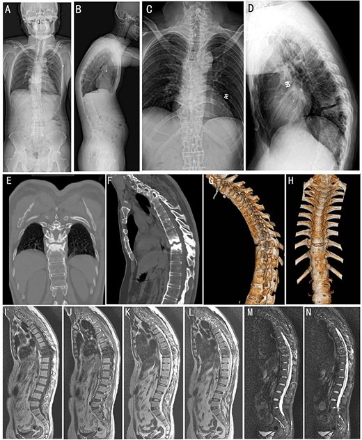 Preoperative imaging studies. (A and B) Full-length orthopantomogram of the spine. (C and D) Anteroposterior and lateral X-ray of the thoracic spine. (E and F) Sagittal and 3D reconstruction CT images (G and H) of the thoracic spine. Whole-spine MRI images of T1-weighted (I and J), T2-weighted (K and L), and short tau inversion recovery sequences (M and N), respectively.