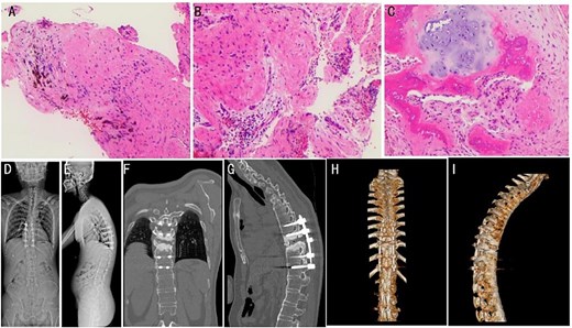 (A–C) Intraoperative pathology specimens obtained for further analysis. (D and E) Post-operative full-length spinal X-ray images. Typical post-operative Sagittal (F and G) and 3D CT reconstruction (H and I).