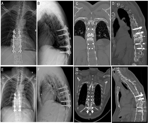 Post-operative follow-up images at different time periods. X-ray images were followed up 4 months after the surgery (A and B). CT images of patients were followed up 1 year after the surgery (C and D). X-ray (E and F) and CT (G and H) images were followed up 2 years after the surgery.