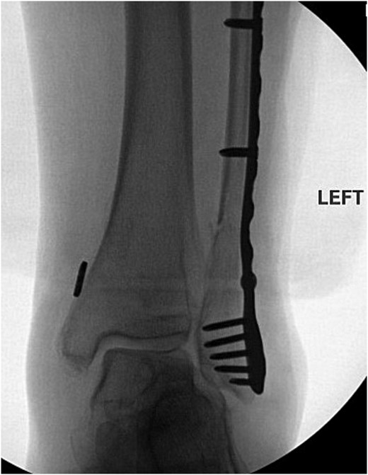 Anterior–posterior post-operative X-ray demonstrating fixation of left Weber C fibular fracture.
