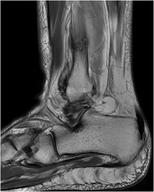MRI demonstrating acute Weber C fibular fracture with partial-thickness tearing of the syndesmotic membrane of the right lower extremity.