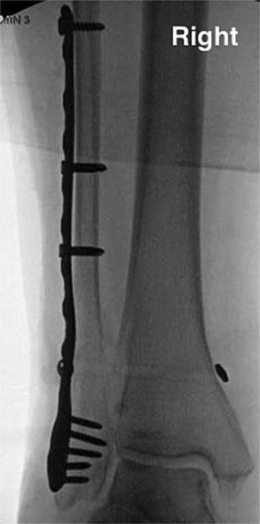 Anterior–posterior post-operative X-ray demonstrating fixation of right Weber C fibular fracture.