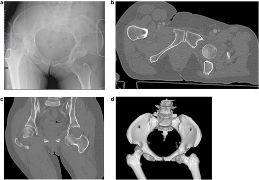 Imaging results at the time of transport. (a) Initial pelvic radiograph showing left femoral head dislocation. (b) Axial CT image showing femoral head displaced into the obturator foramen. (c) Coronal CT image showing inferior and medial displacement of the femoral head. (d) 3D reconstructed CT image showing the femoral head in the obturator foramen.