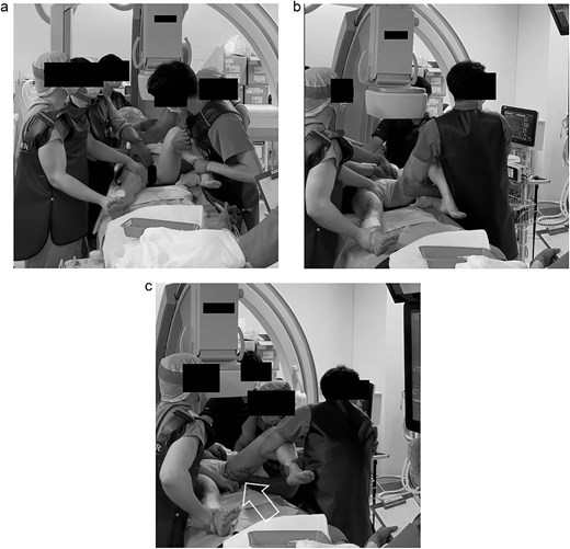 The manual reduction techniques we tried. (a) First reduction attempt: flexion, adduction, and internal rotation (unsuccessful). (b) Second reduction attempt: flexion, abduction, and internal rotation (unsuccessful). (c) Successful reduction with flexion, abduction, and external rotation, with anterior pressure.