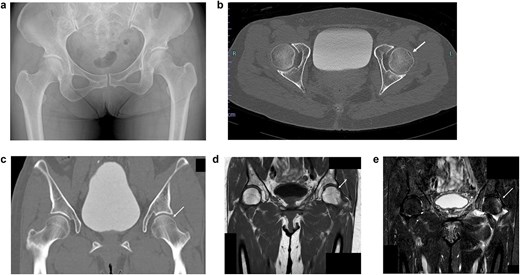 Imaging results immediately after manual reduction. (a) Post-reduction pelvic radiograph confirming reduction. (b) Post-reduction axial CT image confirming reduction. (c) Post-reduction coronal CT image confirming reduction. (d) T1-weighted MRI showing a subchondral band-like low signal area. (e) STIR MRI showing diffuse high signal intensity beneath the subchondral lesion.